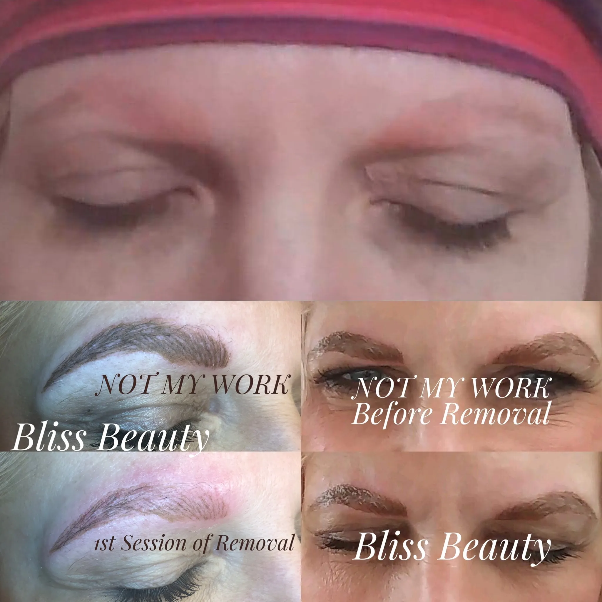 Tattoo removal before and after